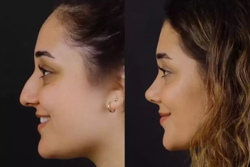 Breathe Better, Look Sharper: Why More People Are Choosing Rhinoplasty in Dubai