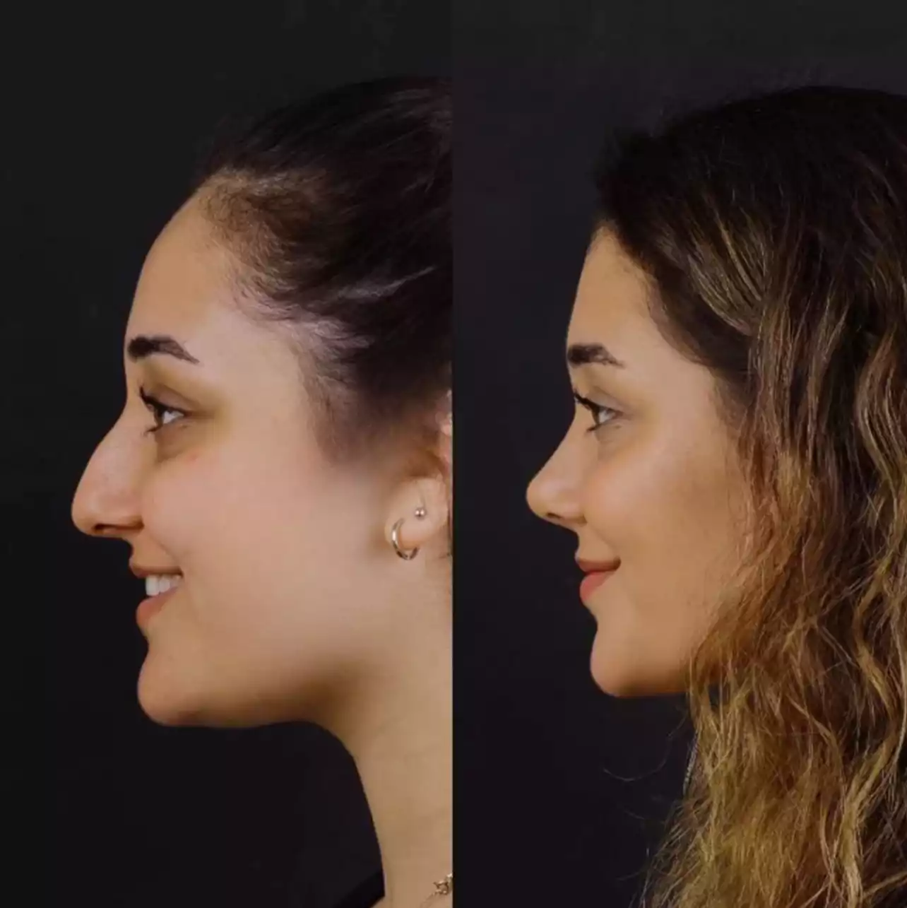 Breathe Better, Look Sharper: Why More People Are Choosing Rhinoplasty in Dubai